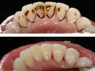 dentes com tártaro devido ao fumo antes e depois de limpeza
