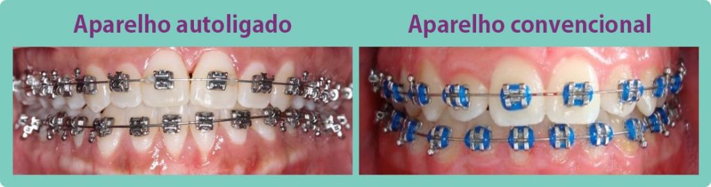 Comparação lado a lado de aparelho autoligado e convencional.