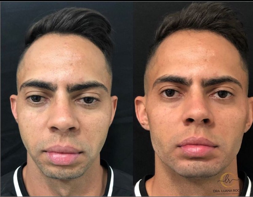 Antes e depois de harmonização em homem.