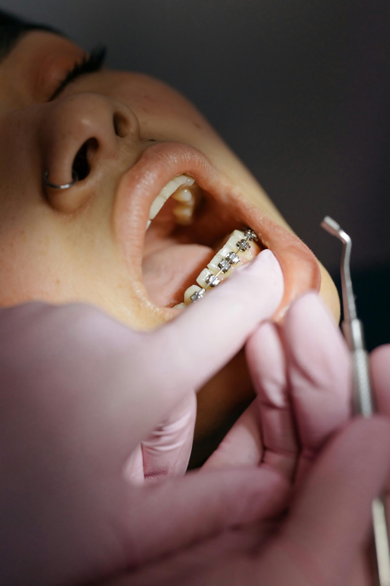 Dentista colocou aparelho ortodôntico nos dentes de baixo da paciente, e está segurando o lábio inferior dela.
