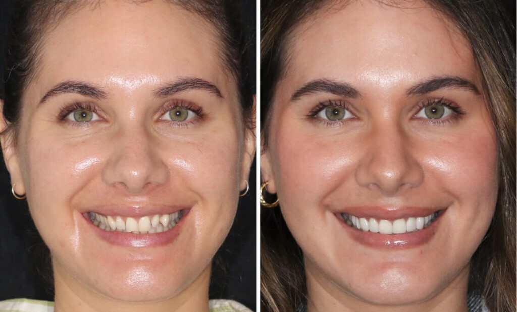 Antes e depois dos dentes de uma mulher que colocou dentes de porcelana.