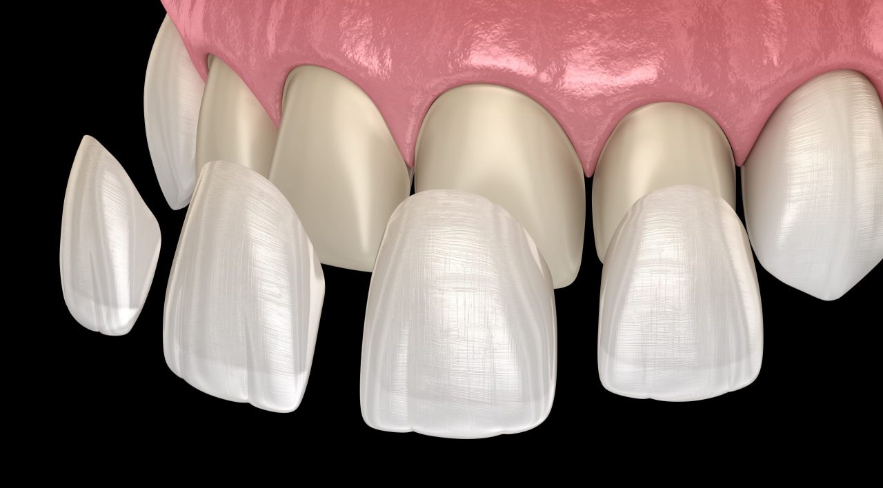 Imagem digital mostrando os dentes reais de uma pessoa e por cima chegando os dentes de porcelana.