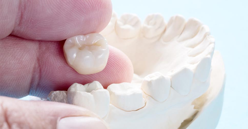 Molde de boca e pessoa segurando um dente de porcelana ao lado