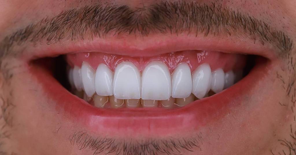 Paciente homem usando facetas dentárias de porcelana