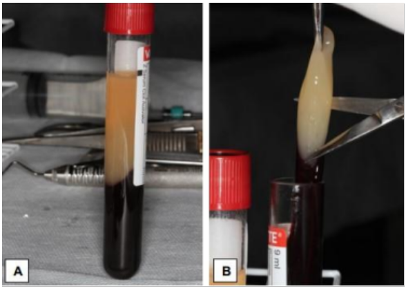 Imagem A com Membrana L-PRF em tubo e imagem B cortando essa membrana.