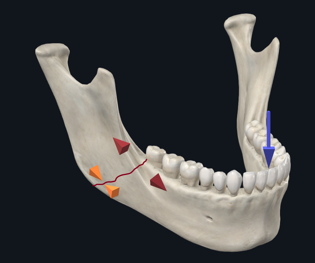 Imagem de osso da mandíbula e desenhos mostrando fratura, precisará de cirurgia e traumatologia bucomaxilofacial.