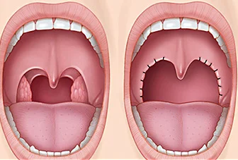 Desenho mostra antes e depois de cirurgia para apneia do sono.