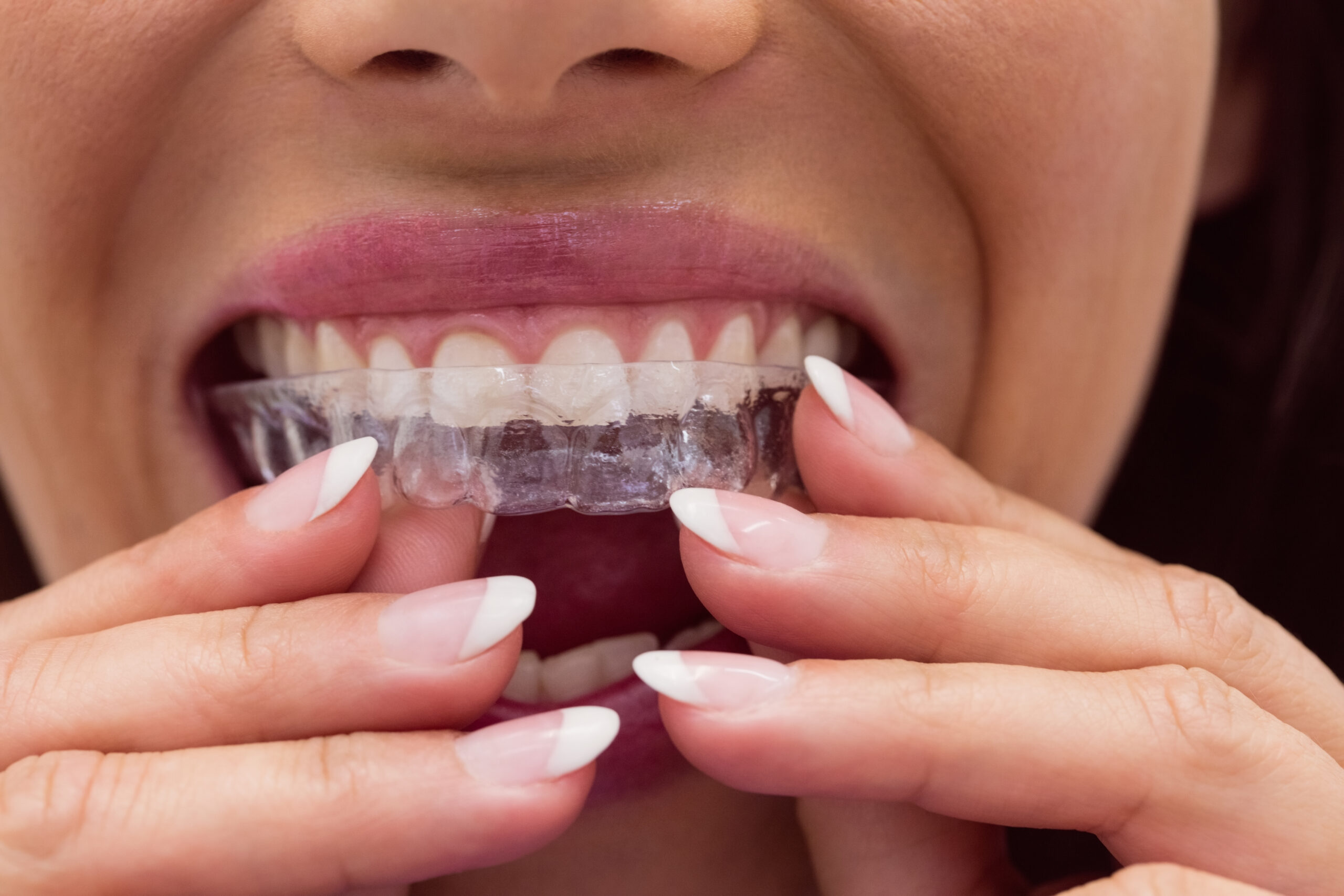 mulher colocando aparelho transparente no dente
