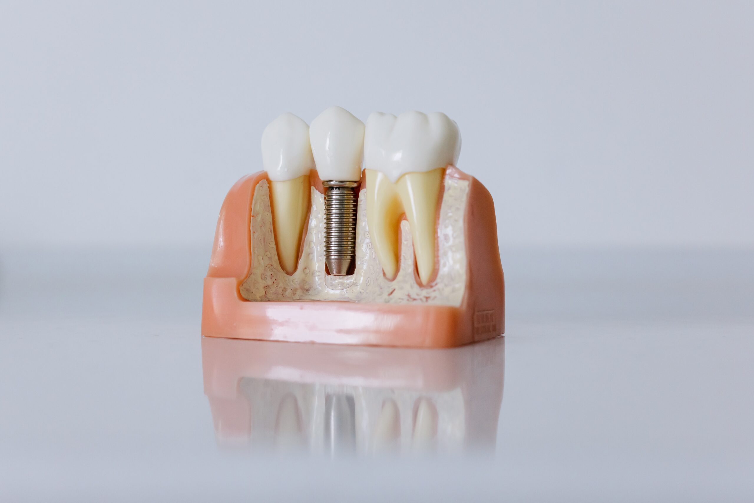molde de implante dentário