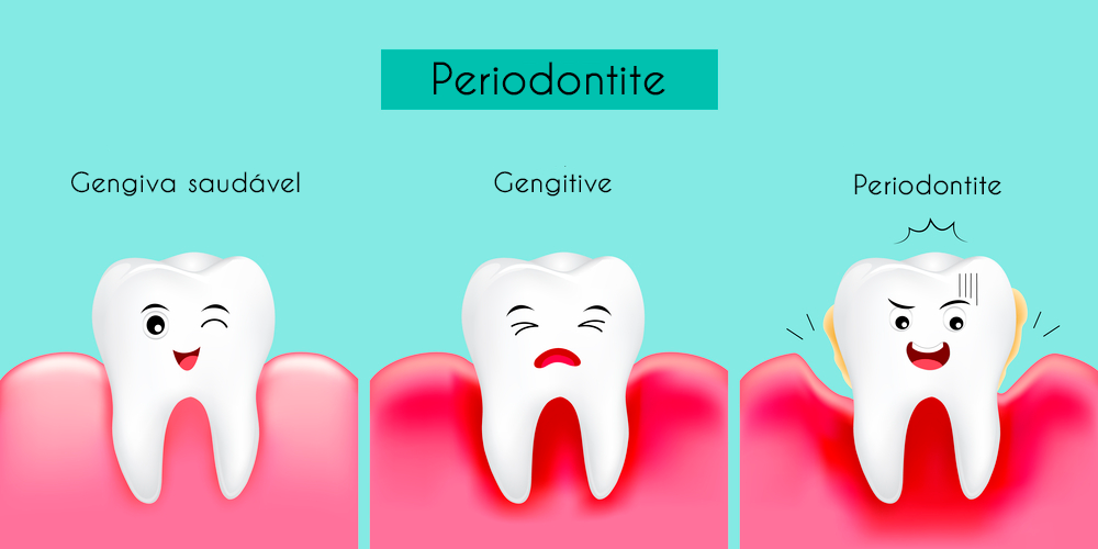 imagem mostrando a diferença de uma gengiva saudável, uma com gengivite e outra com periodontite.