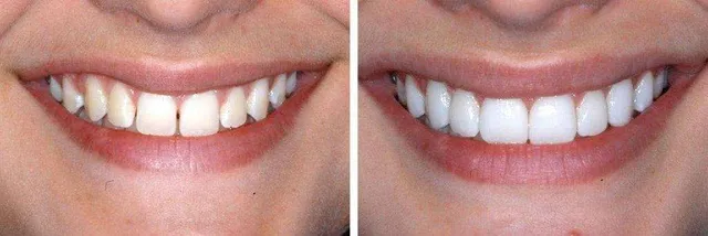 antes e depois de colocar resina e preencher os dentes