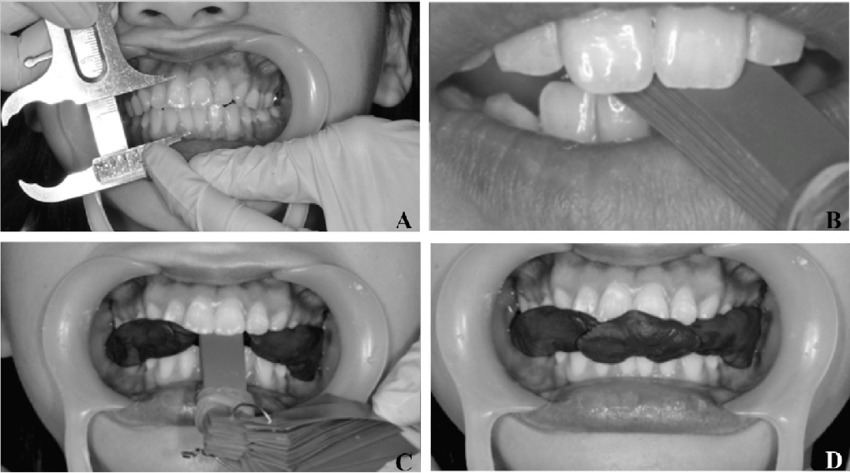 4 partes mostrando tirando as medidas da DVO (Dimensão Vertical de Oclusão)