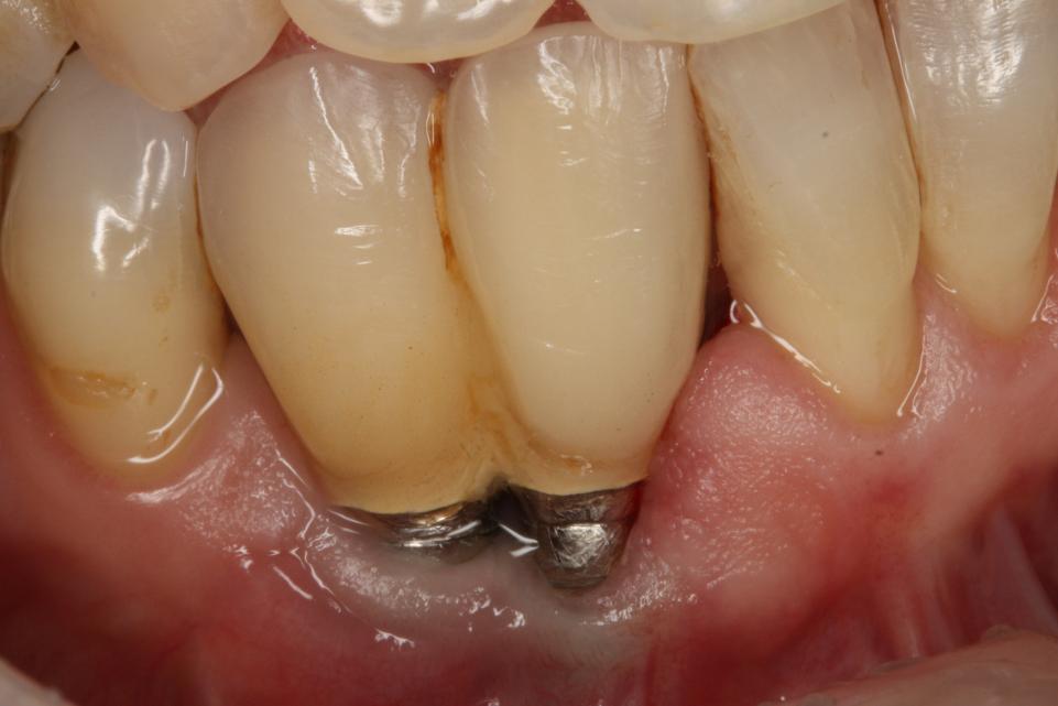 É possível ver os pinos do implante devido a peri-implantite.