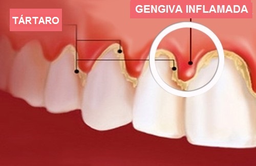desenho mostra dentes com tártaro e gengiva inflamada