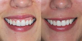 antes e depois de botox em mulher com sorriso torto