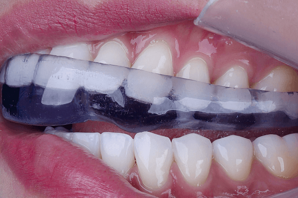 mulher usando Placas miorrelaxantes