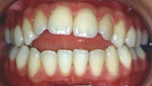 Boca de paciente que tem deglutição atípica.