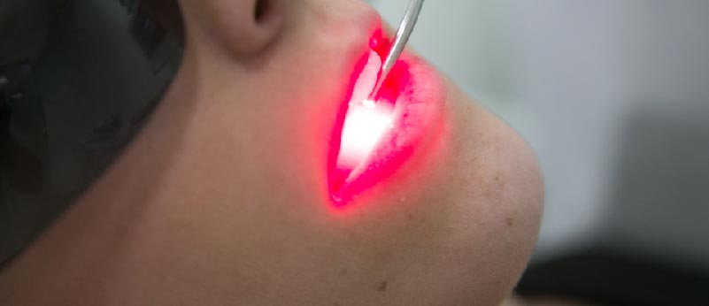 Realizando laserterapia em boca de paciente; O laser tem luz vermelha e o paciente usa óculos escuros de proteção.