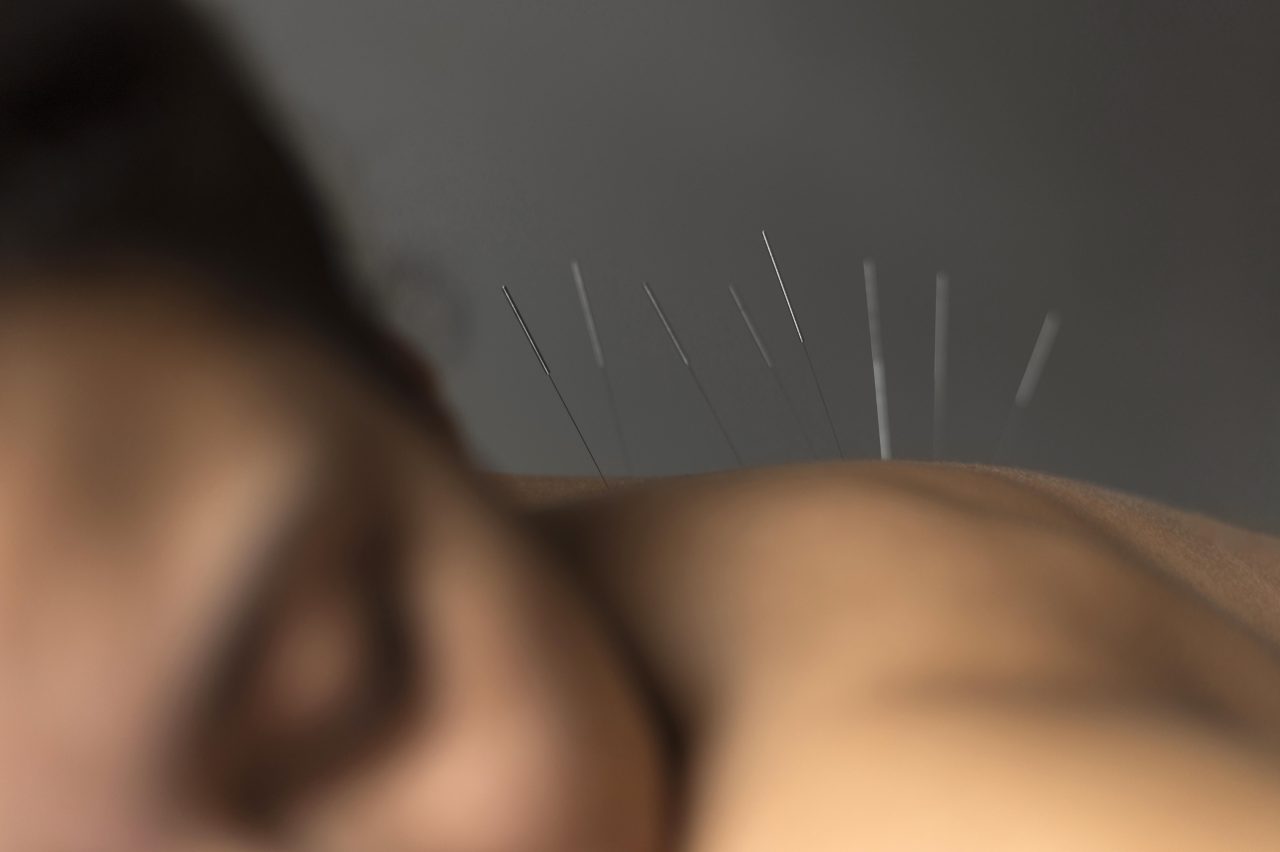 mulher deitada com agulhas de acupuntura nas costas
