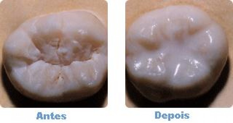Antes e depois de aplicar selante dental em cárie.