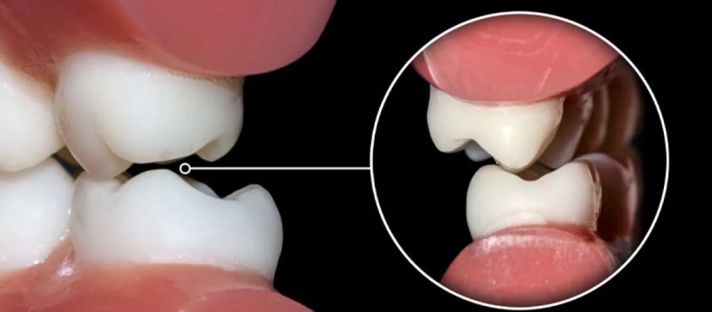 Imagem de dentes rangendo e um zoom mostrando onde eles estão se encontrando