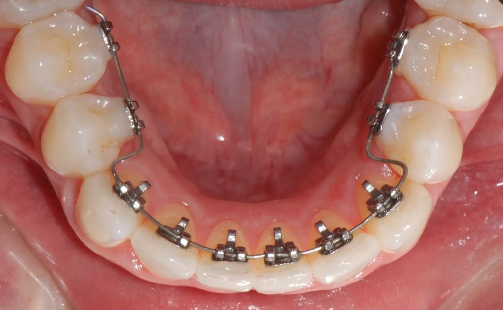 foto da parte interna da boca, mostrando braquetes linguais