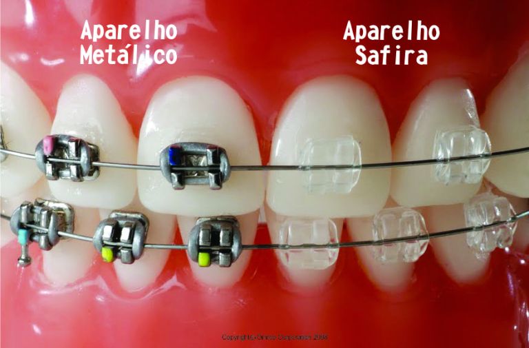 Aparelho de Safira: Entenda a Diferença para o Metálico