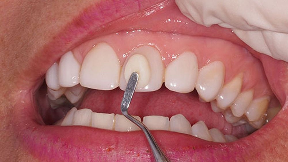 foto de colocando resina no dente do paciente