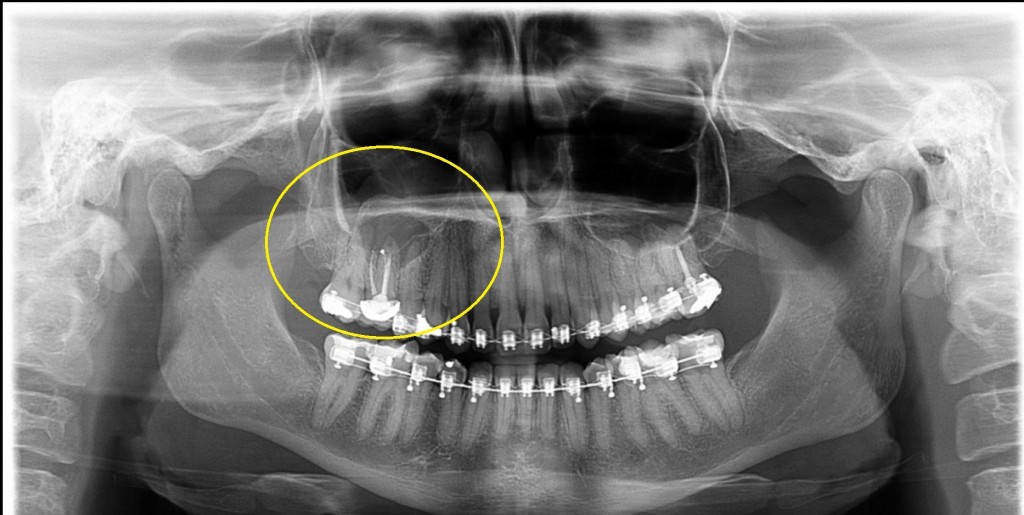 Imagem de panorâmica de pessoa que usa aparelho ortodôntico e dá pra ver cisto circulado em dente de cima