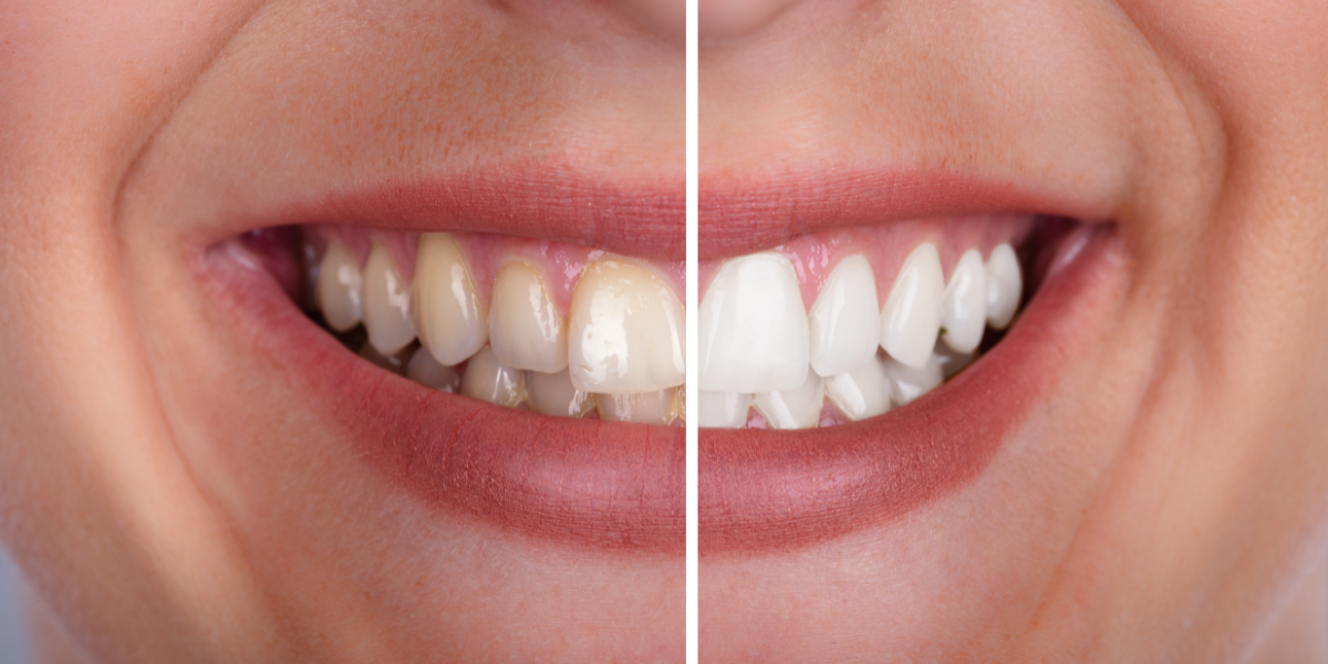Antes e depois de clareamento dental.