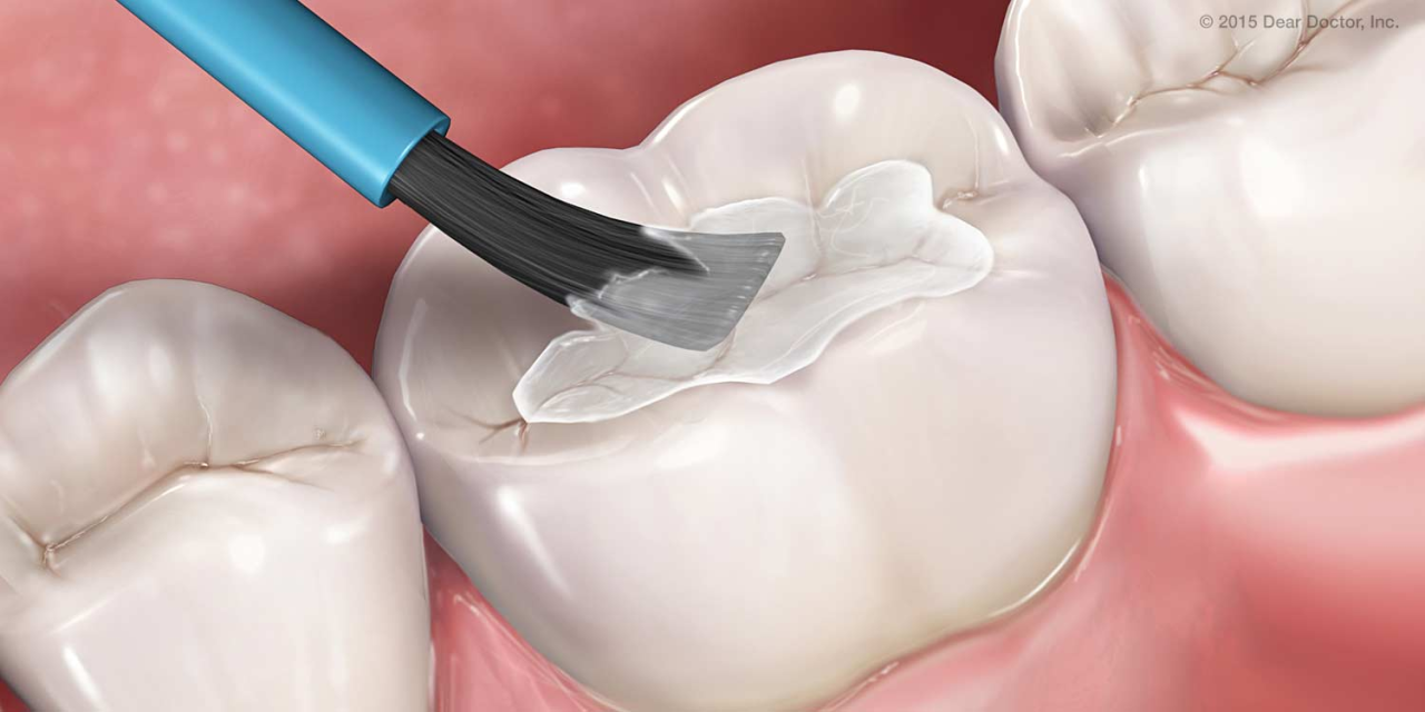 Imagem digital mostra aplicação de flúor em dente.