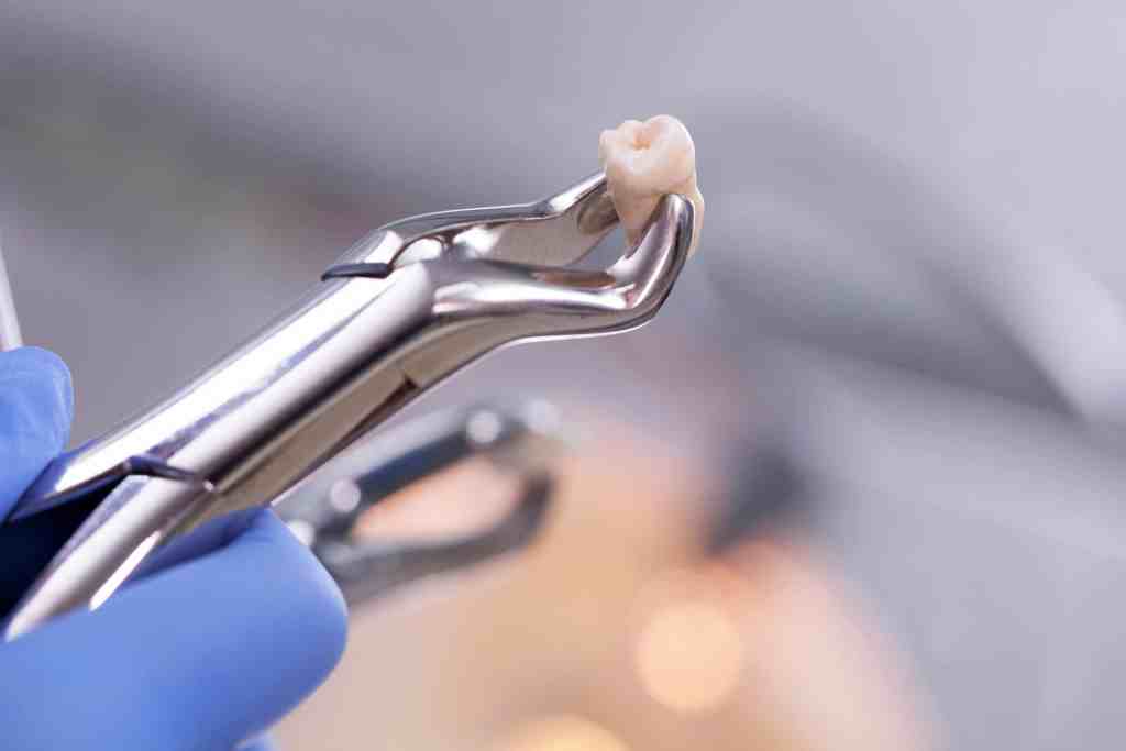 extração dentária, segura o dente no alicate