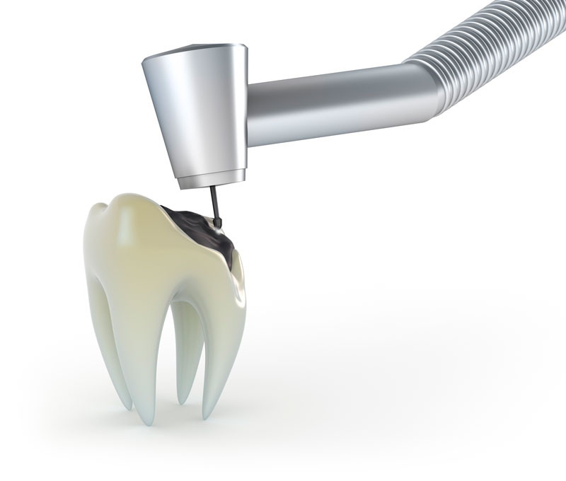 Desenho de dente com cárie e aparelho fazendo restauração.