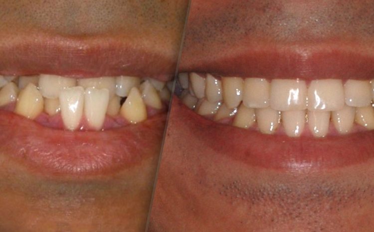 antes e depois de paciente com apinhamento dental