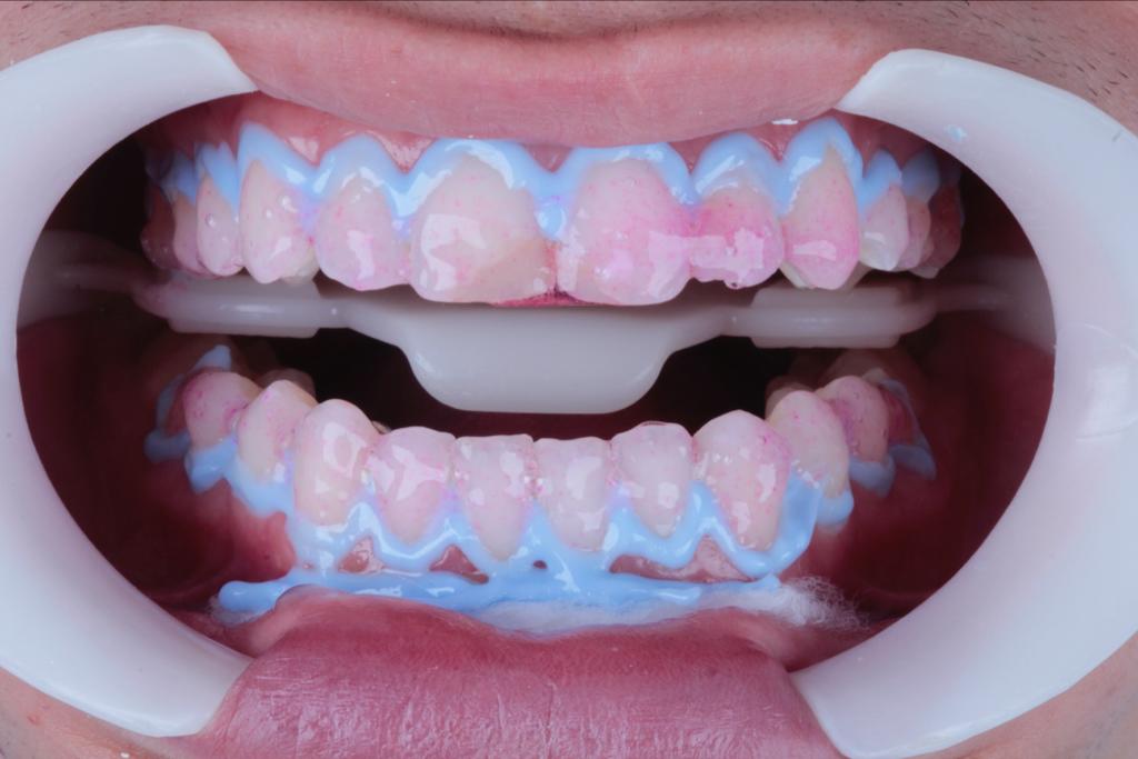 Dentes com gel azul claro, é um clareamento de consultório