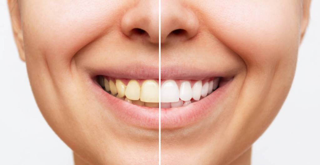 comparação de antes e depois de clareamento dental de mulher