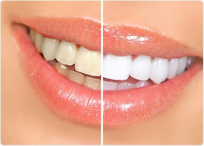 comparação de antes e depois de clareamento dental de mulher