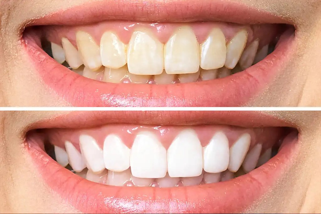 comparação de antes e depois de clareamento dental de mulher