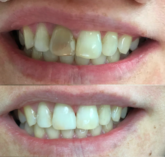 Antes e depois de clareamento interno. No antes, o dente da frente da pessoa está mais escuro que o resto. No depois, está igualado.