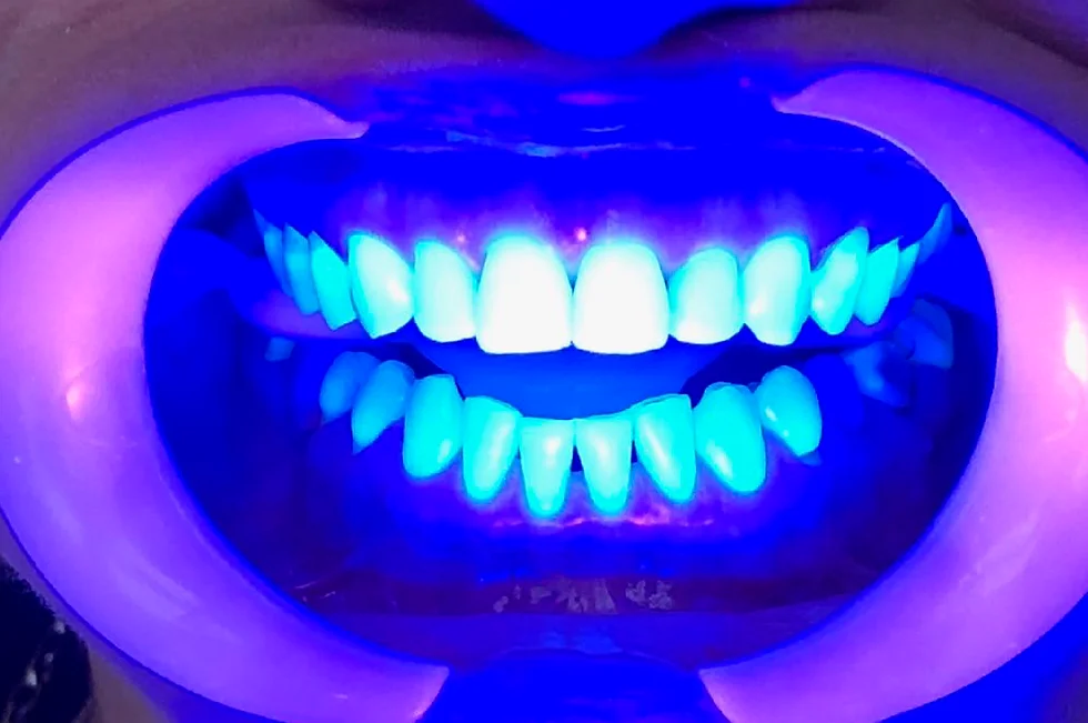 Está sendo feito um clareamento com luz ultravioleta