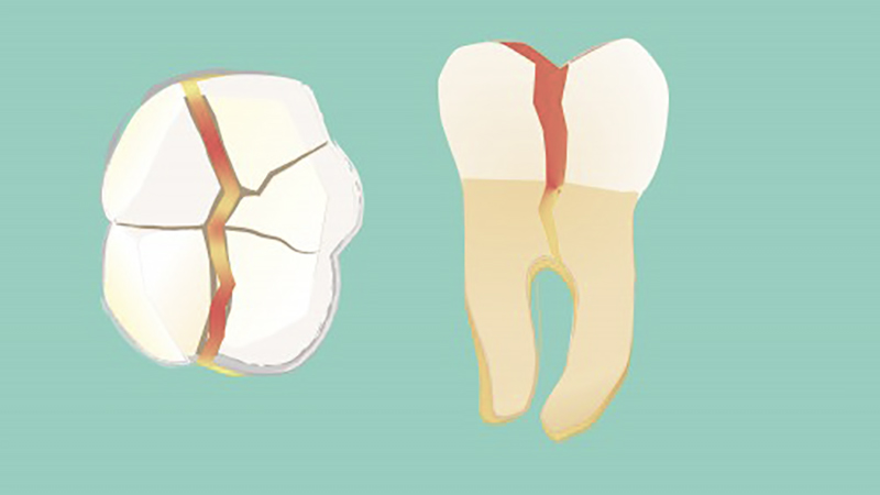 desenho de dente fraturado com a raiz exposta