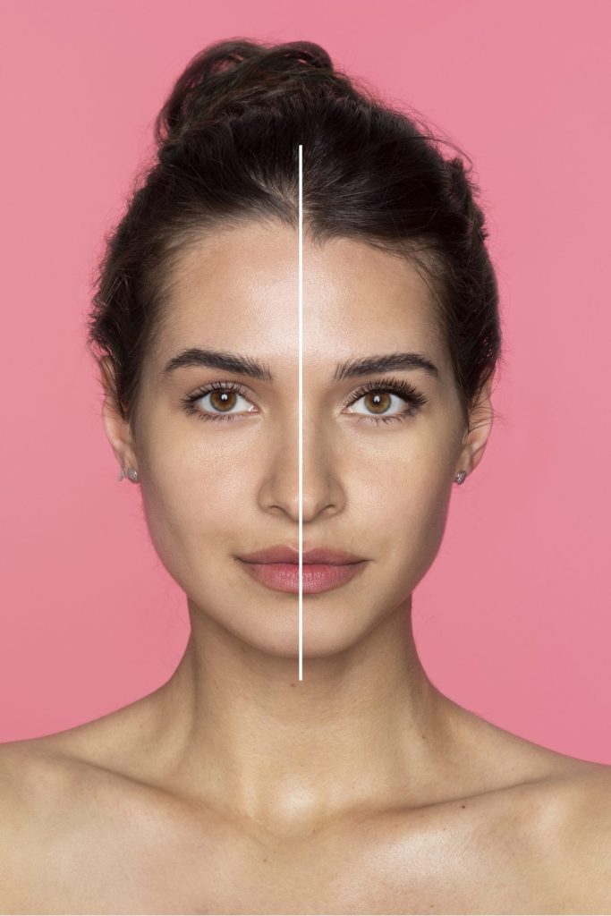 antes e depois de harmonização orofacial de mulher