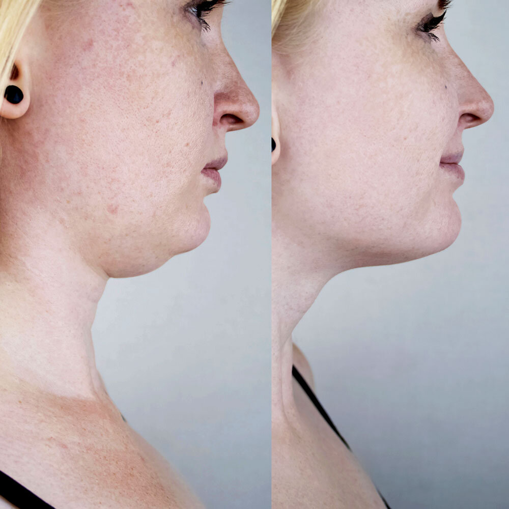 antes e depois de harmonização orofacial de mulher