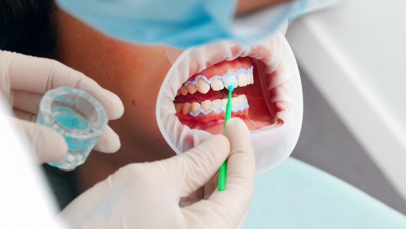 Dentista aplicando produto de clareamento nos dentes do paciente