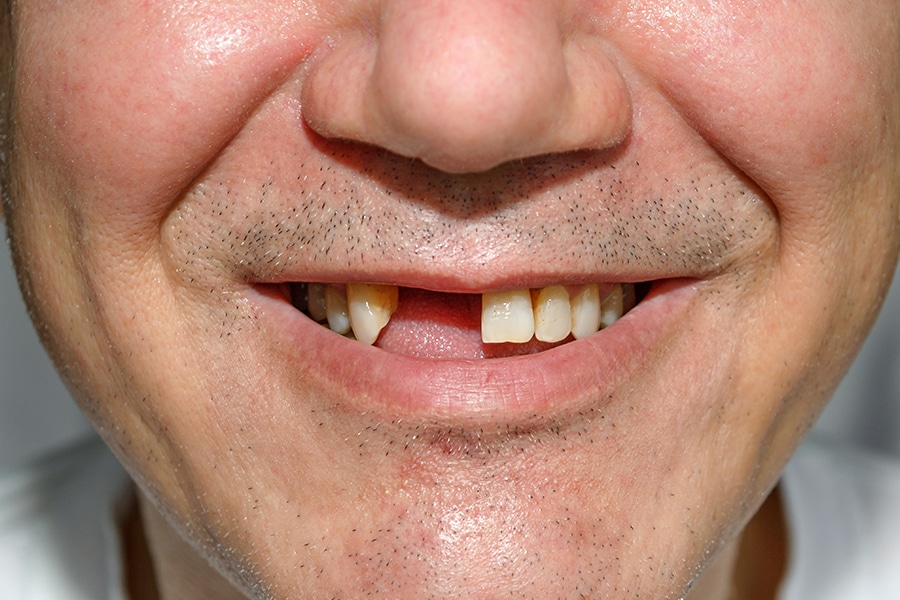 homem com barba por fazer está sorrindo, está faltando os dois dentes superiores.