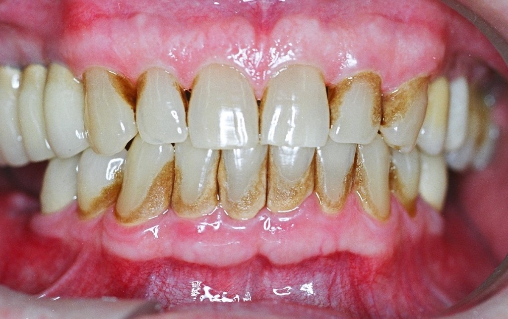 Periodontia evidente em diabético.