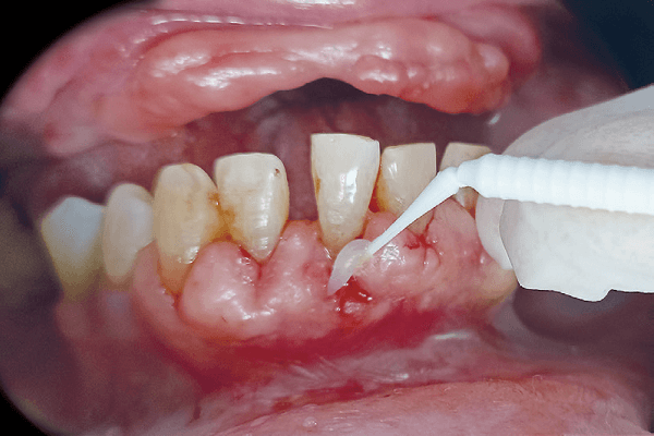 Tratando periodontia inflamada em diabético.