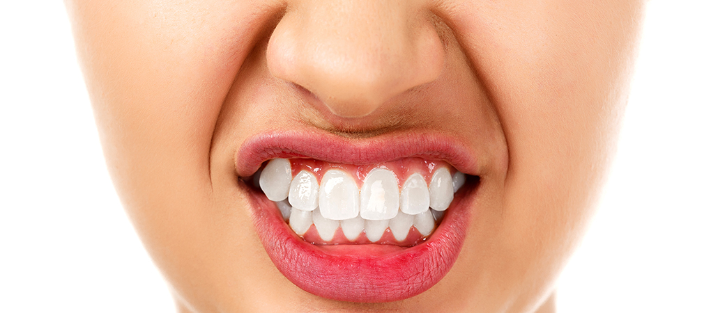 Mulher apertando os dentes com bruxismo