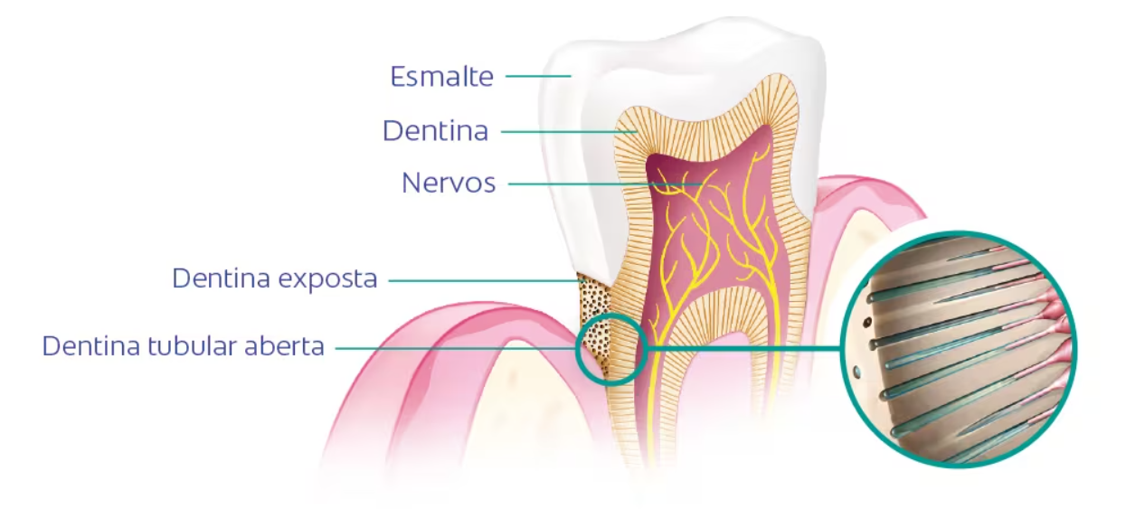 imagem técnica das partes do dente para mostrar onde ocorre a Hipersensibilidade Dentinária