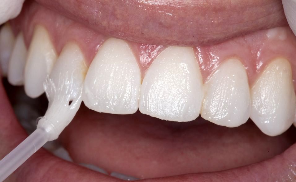 passando uma solução com flúor nos dentes do paciente